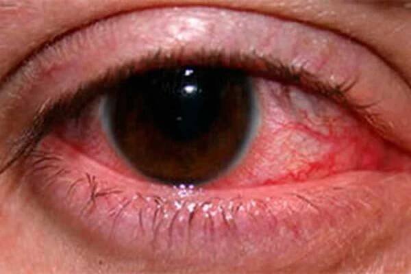 Rosacea se podívá, co dělat? / Rosacea | Užitečné informace a tipy na péči o sebe. Zdraví, výživa a další.