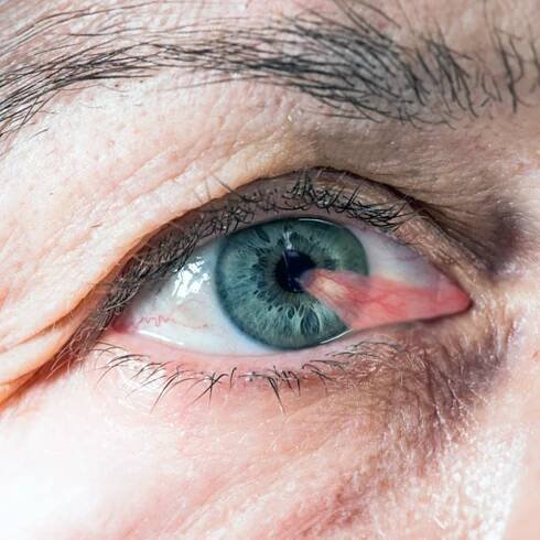 PTERYGIUM SURGERY