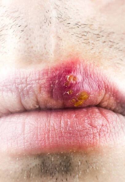 herpes labialis na rtu kavkazského muže. obličej zblízka.
staré vředy, nemoc, nemoc. simplex virus. - herpes zoster - stock snímky, obrázky a fotky