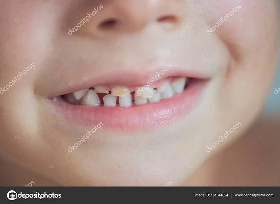Stáhnout - Detailní záběr dětských zubů s caries. — Stock obrázek