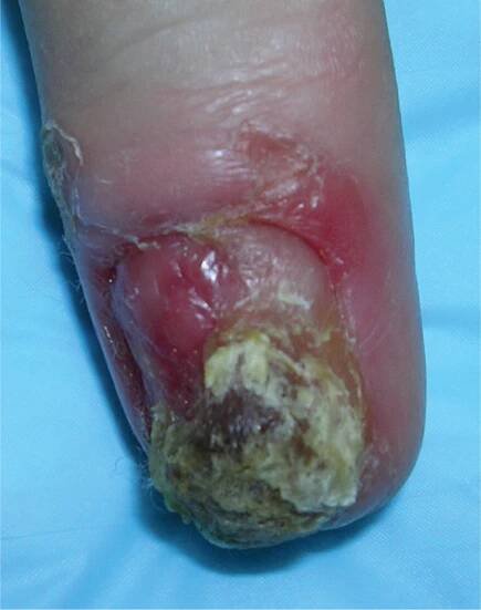 Evaluation of Nail Abnormalities | AAFP