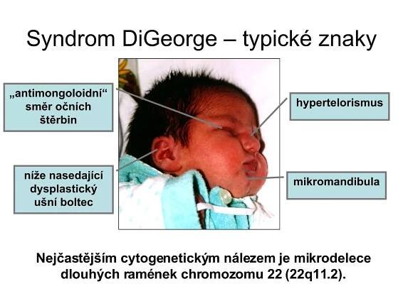 Syndrom DiGeorge – typické znaky Nejčastějším cytogenetickým nálezem je mikrodelece dlouhých ramének chromozomu 22 (22q11.2). hypertelorismus mikromandibula níže nasedající dysplastický ušní boltec „ antimongoloidní“ směr očních štěrbin 
