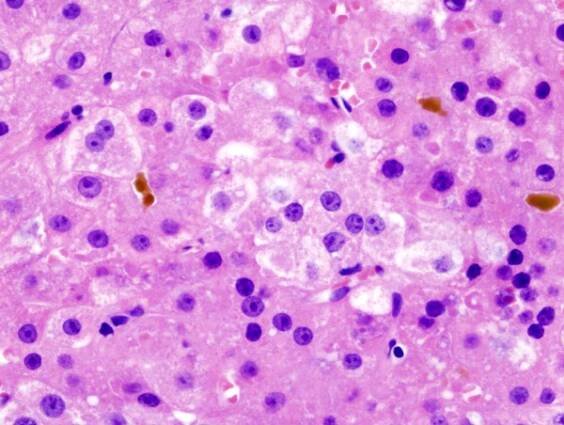 Hepatitida C – WikiSkripta