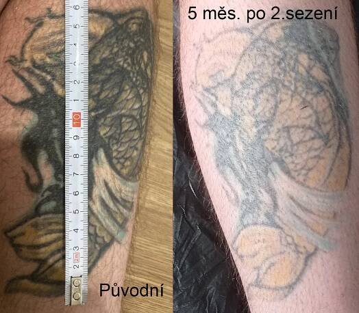 Galerie odstraněných tetování - Filips Tattoo