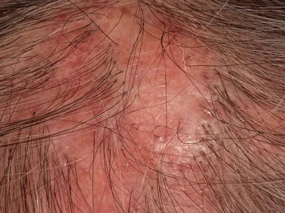 Lichen planus (overview)
