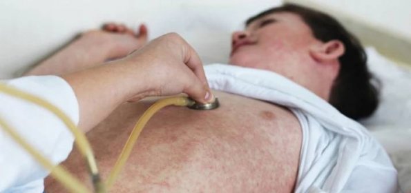 Obávané spalničky mají typické příznaky: Jak probíhá jejich léčba, když očkování selhalo?