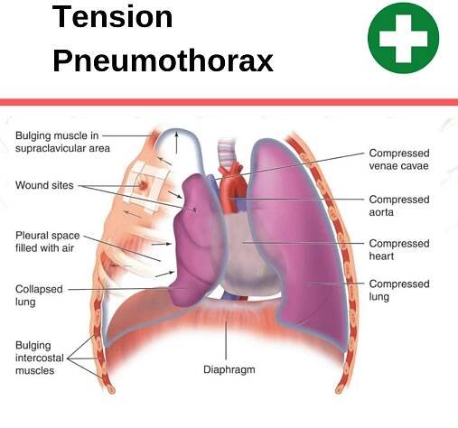 Can CPR Cause a Pneumothorax (collapsed lung)?