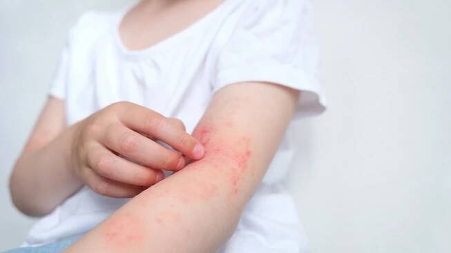 5 hlavních příčin ekzémů a způsoby jejich přirozeného léčení pomocí stravy