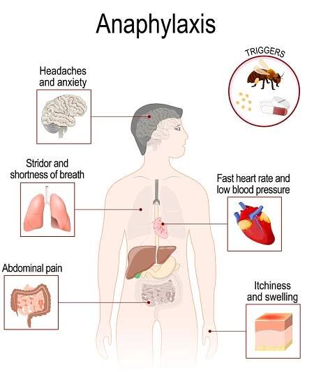 Anaphylaxis Myths and Facts
