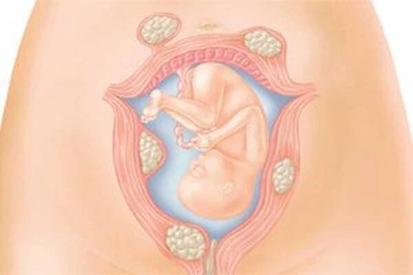 Uterinní fibroidy během těhotenství / Děložní myom | Užitečné informace a tipy na péči o sebe. Zdraví, výživa a další.