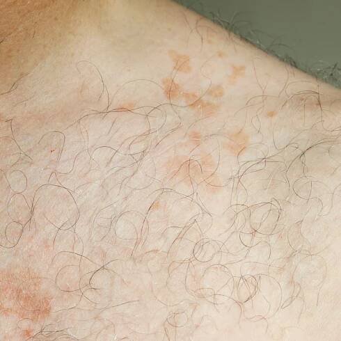 Skin Rash Diagnosis & Treatment TX | Radiant Dermatology & Aesthetics
