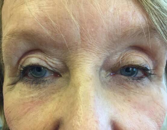 Instantly Ageless™ | Vermont Facial Aesthetics | Reading Vermont