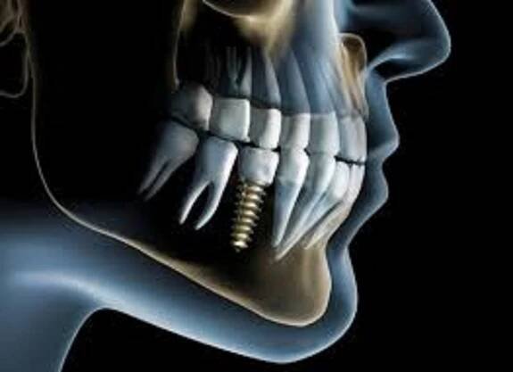Reasons Why Dental Implant Failure Can Happen