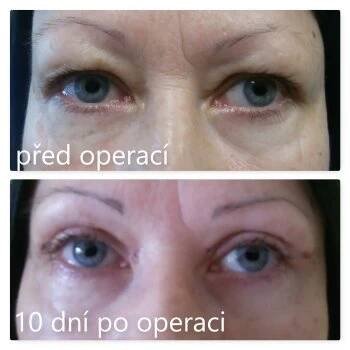 Operace horních víček | Niké Clinic.cz