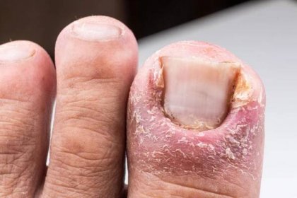 Detailní zánět bolestivé infekce palce v důsledku zarostlé nehty na noze — Stock fotografie