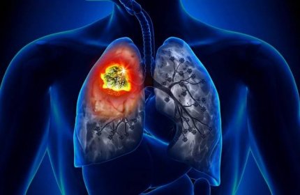 Těžce se vám dýchá, máte kašel a bolest těla? Rané signály rakoviny plic jsou podobné chřipce. Jak je rozeznat?