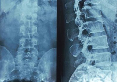 rentgenové paprsky páteře - ochrnutí - stock snímky, obrázky a fotky