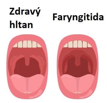 Faryngitida