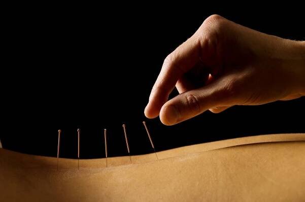 Medical Acupuncture - BodyWorks Sports & Remedial Massage