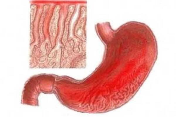 Povrchová gastroduodenitida / Gastroduodenitis