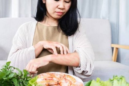 asijské ženy svědění, vyrážky, kůže a poškrábání paží způsobené potravinovými alergiemi po jídle krevet - kopřivka - stock snímky, obrázky a fotky