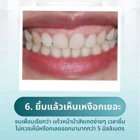 veneer-dental-09