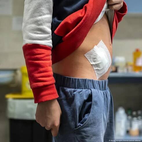Appendix cancer rises in young people — but why?