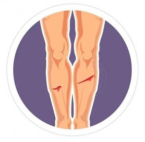 Krvácení poranění kůže řez nebo pomocné nohy bolest izolovaných vektorové ikony nohy krvácení rány medicíny a zdravotnictví teče krev stop a léčba traumatu infekce prevence krytí poškození tkáně. — Ilustrace