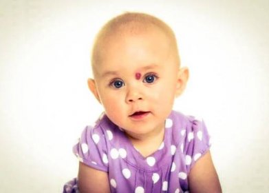 Jsou infantilní hemangiomy pro děti nebezpečné? - ePediatr