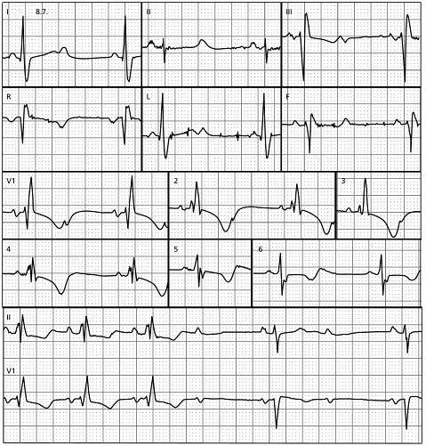 (PDF) ECG interpretation