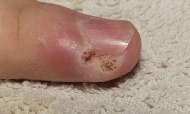 Absces na prstu – léčba panaritia doma
