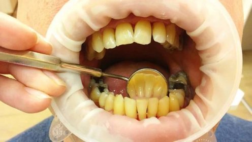 Nemoc obvykle probíhá několik let bez bolestí, a proto také v prvních stádiích nebývá ošetřena. Neléčená parodontitida je nejčastější příčinou ztráty zubů.