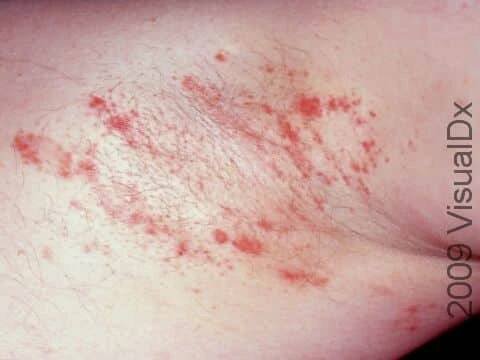 Intertrigo (irritation of body fold areas) may be displayed as irregular red patches and bumps.