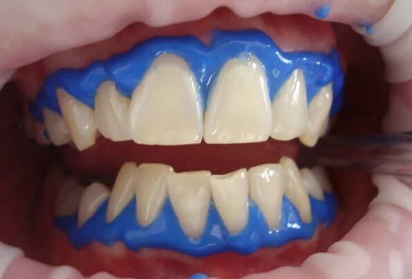 Teeth Whitening Or Bleaching