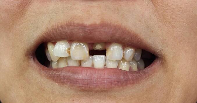 ORAL HEALTH AND MALNUTRITION