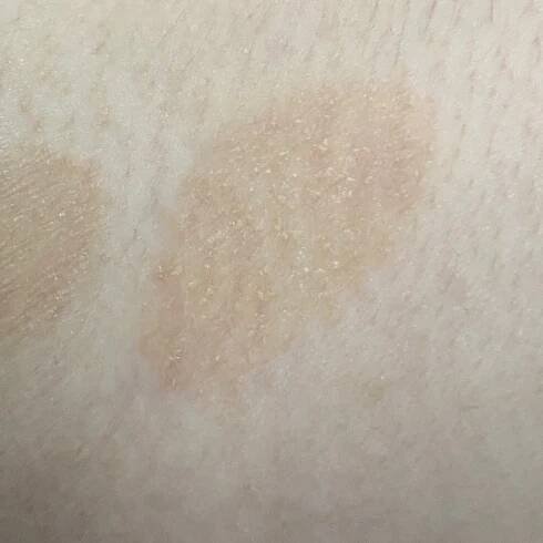Pityriasis versicolor (ICD-10: B36.0) - Online consultation AI dermatologist