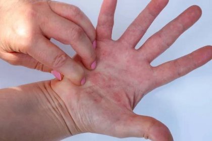 Žena škrábání svědivé ruce, Atopic dermatitida, červená ruka, dermatologický problém, senzibilizace, minimální koncepce, bílé pozadí — Stock obrázek