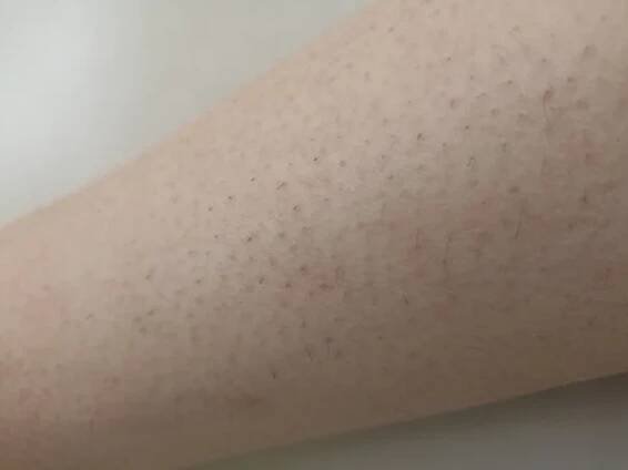 Vyrážka ekzém dermatitida na noze. zánět kůže — Stock obrázek
