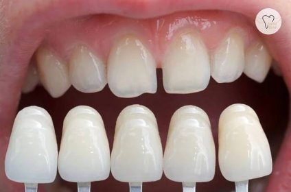 Na křivé či poškozené zuby pomohou fazety