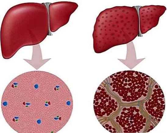 Ascites způsobuje příznaky, stadia, léčbu / Chirurgie | Užitečné informace a tipy na péči o sebe. Zdraví, výživa a další