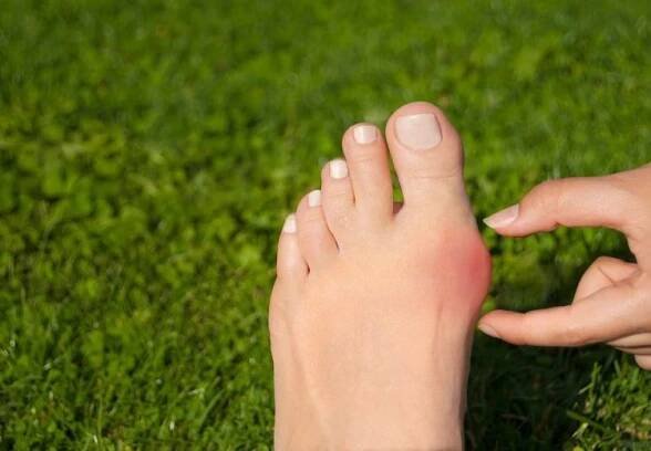 Vbočený palec (hallux valgus) se projevuje bolestí, otlakem a narušením stability přednoží.