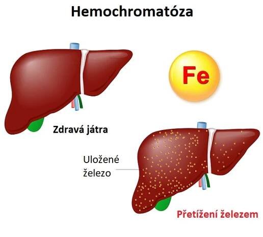 Hemochromatóza - nadměrné ukládání železa v těle - ilustrace