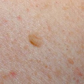 Nevus nebo špeh na lidském těle zblízka. Rakovina kůže, keratóza nebo melanom na kůži. — Stock obrázek