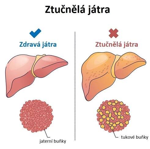 10 způsobů, jak odtučnit játra přirozenou cestou