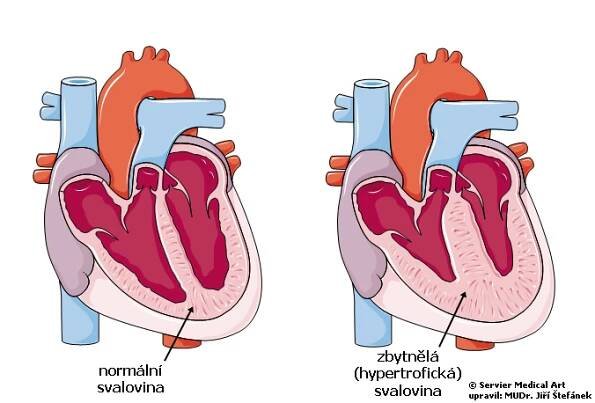 Hypertrofická kardiomyopatie | Medicína, nemoci, studium na 1. LF UK
