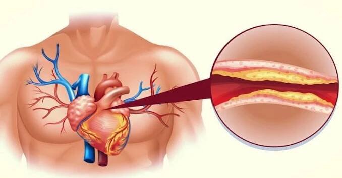 Konec vysokému cholesterolu a ucpaným cévám (přírodní léčba)