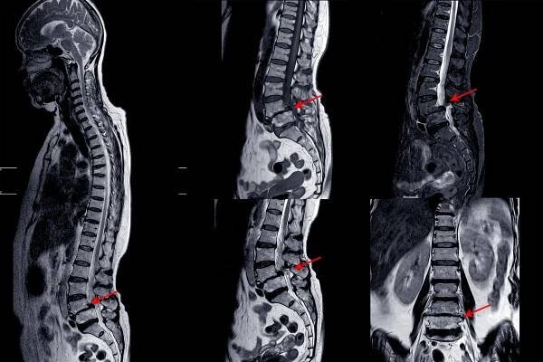 MRI bederní páteře vykazující cervikální spondylozu s mírnou až středně závažnou kompresí míchy při C4-5 a C5-6 s myelopatií — Stock obrázek