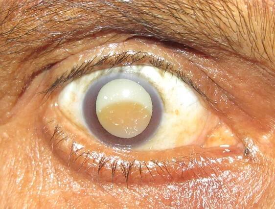 Morgagnian cataract