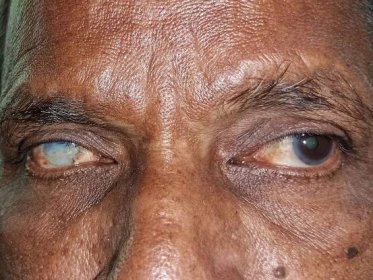 Úplné zakalení rohovky pravého oka v normálním stavu levého oka