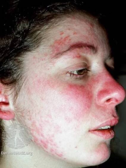 systemic lupus erythematosus